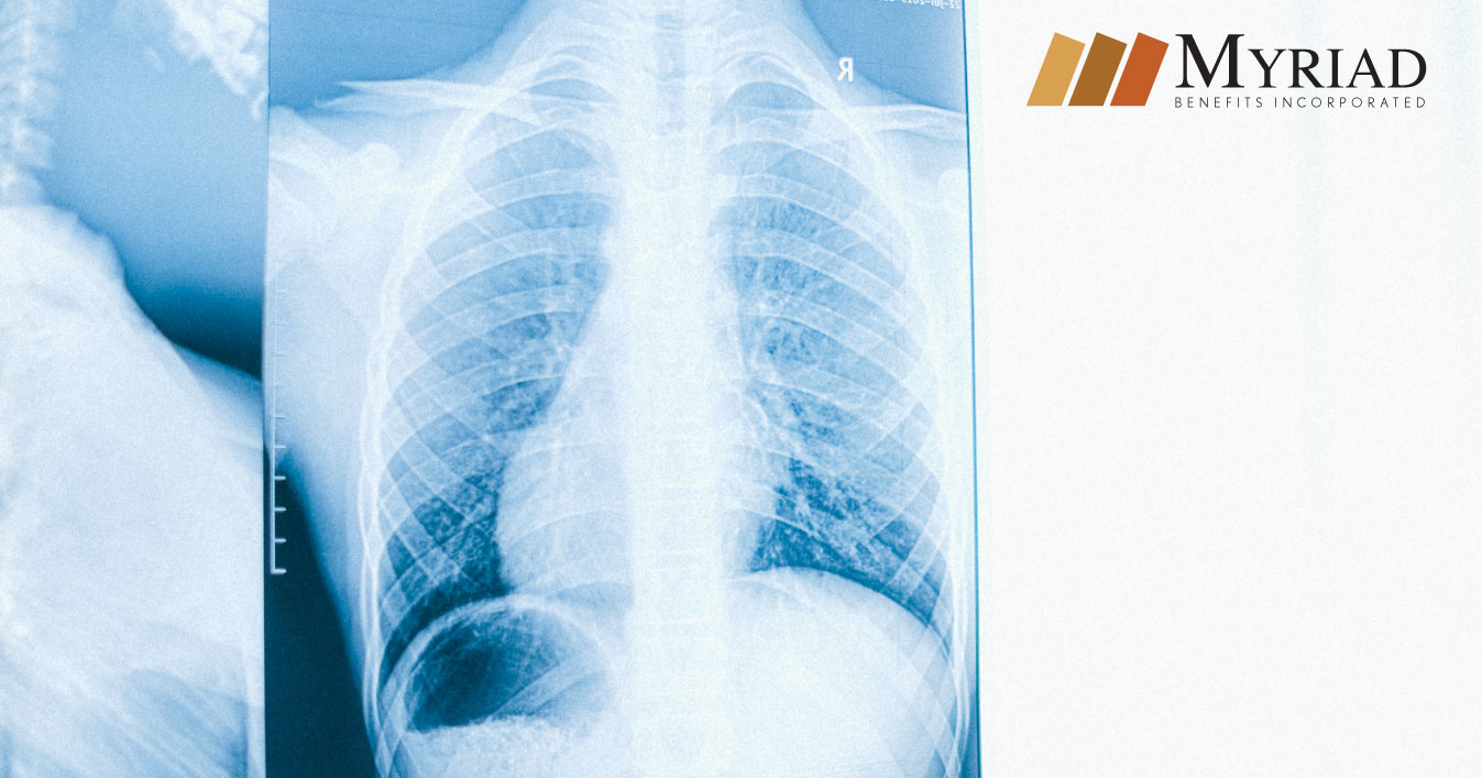radiografía de pulmones